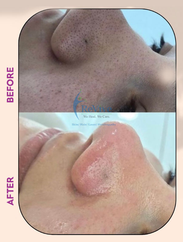 HydraFacial Treatment Dr Manisha Saney Before After