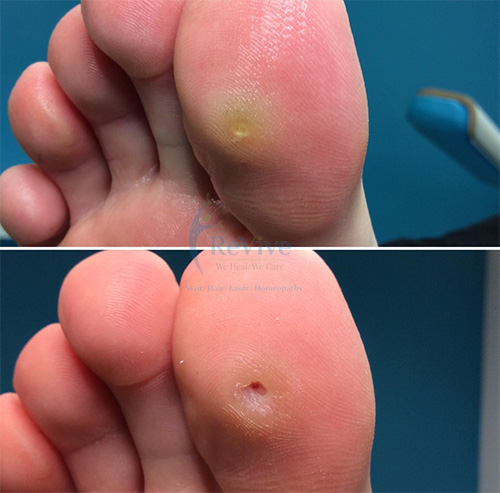 foot corn removal before and after images
