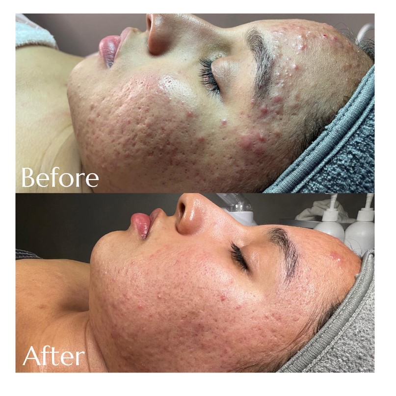 Acne treatment before after results of patient treated by Dr Manisha at Revive Clinic