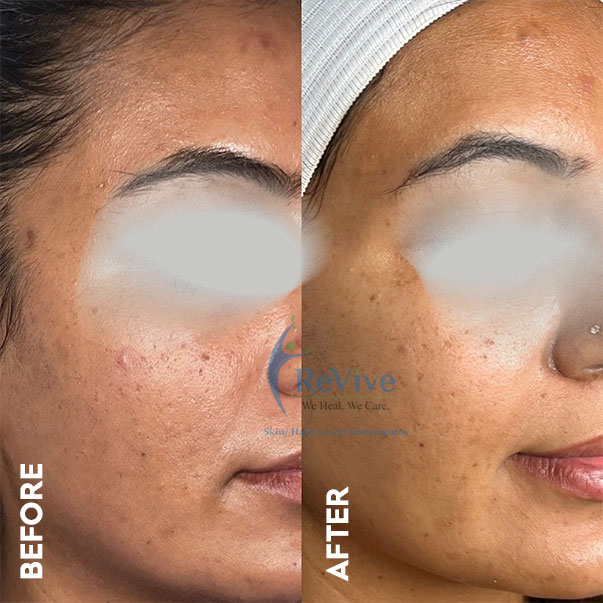 Bridal skin treatment at Revive Clinic in Chembur