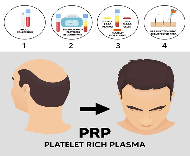 Hair Restoration  The Retreat Medical Spa