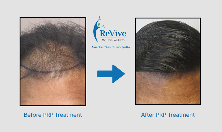 PRP Hair Restoration — MesoHealth