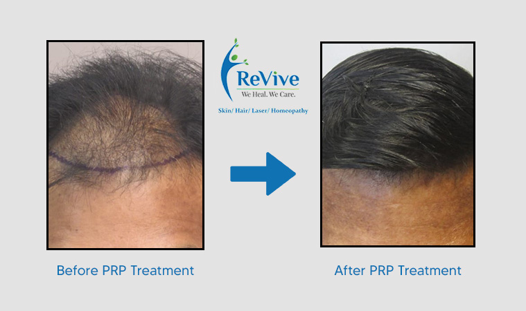 PRP Treatment Before After Result 1