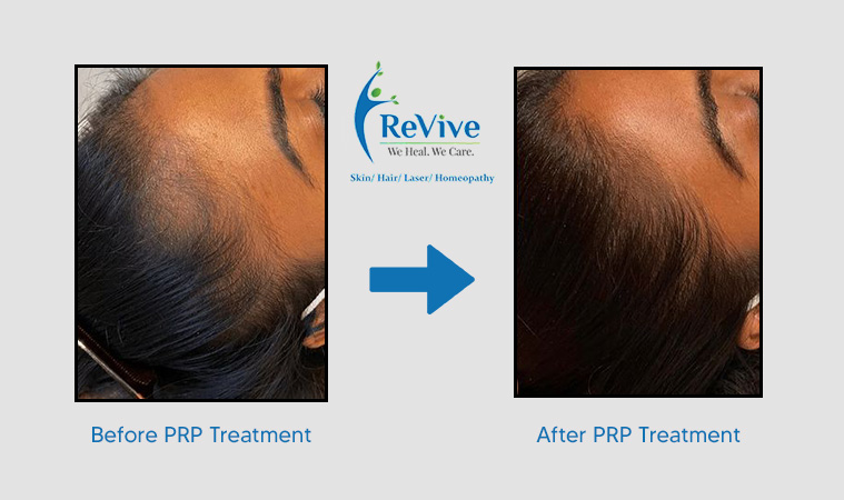 PRP Treatment Before After Result 2