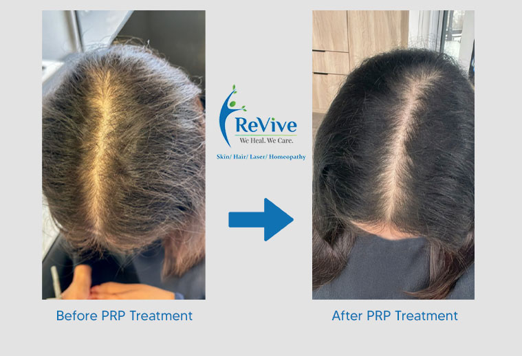 PRP Treatment Before After Result 5