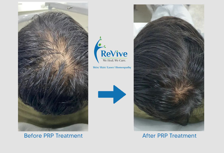 PRP Treatment Before After Result 6