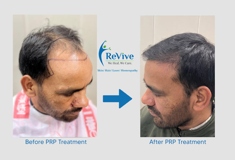 PRP Treatment Before After Result 7