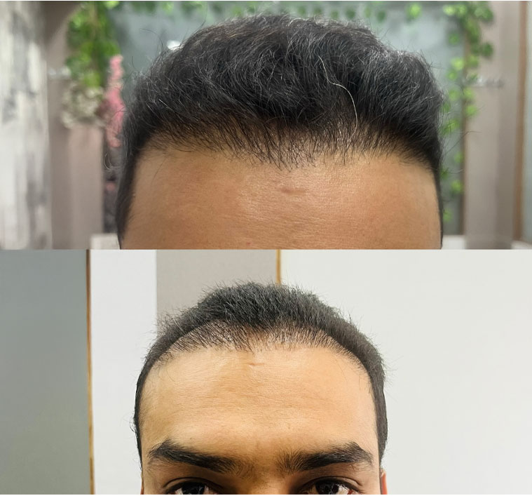 PRP Treatment Before After Result 8