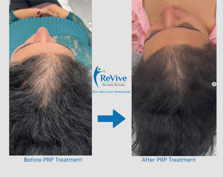 PRP Treatment Before After Result 9