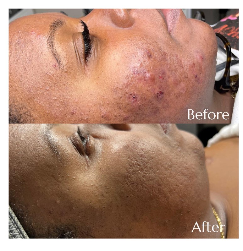 Acne treatment before after results of patient treated by Dr Manisha at Revive Clinic