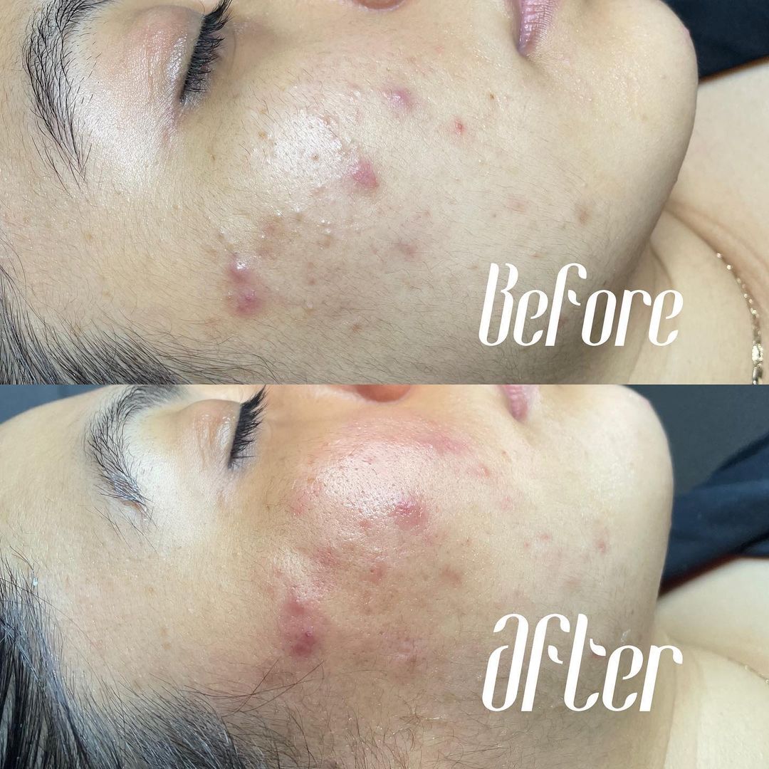 Acne treatment before after results of patient treated by Dr Manisha at Revive Clinic