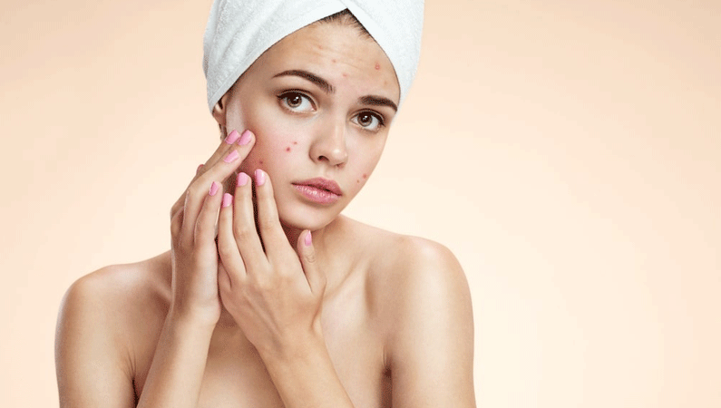  Best Acne Treatment in Kurla 