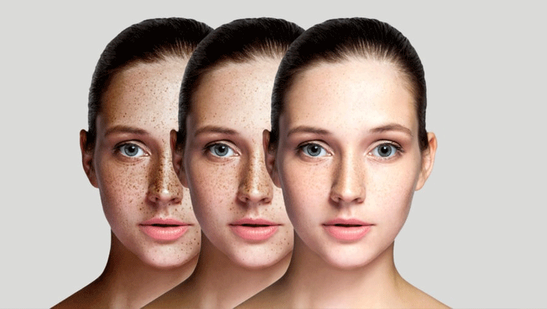 Anti Pigmentation Treatment in Mumbai 