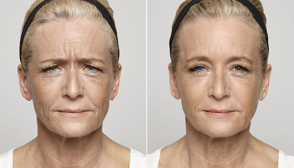 anti wrinkle botox treatment