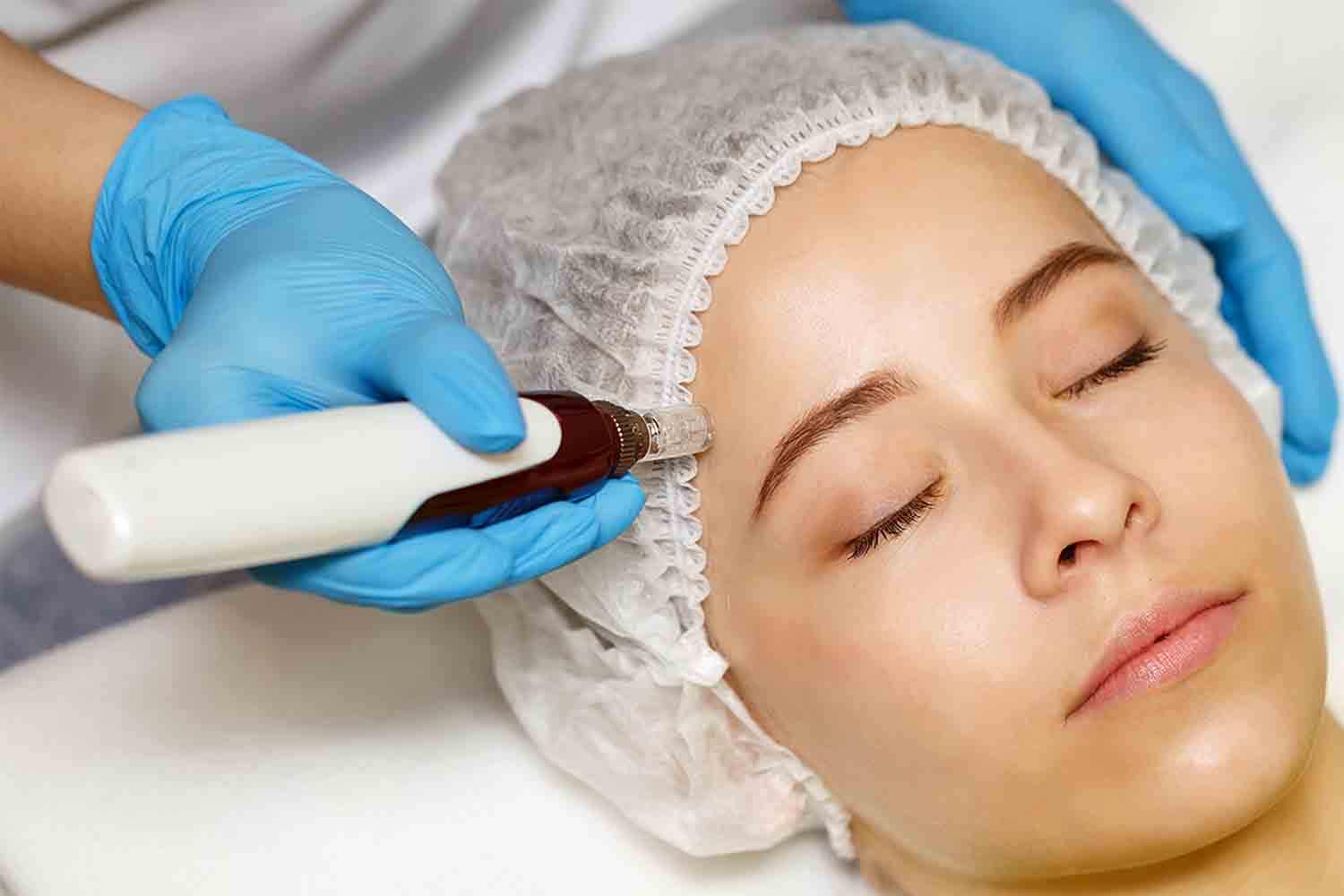 dermapen treatment