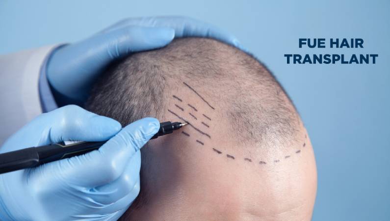 fue hair transplant mumbai