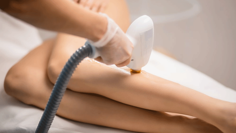 laser hair removal