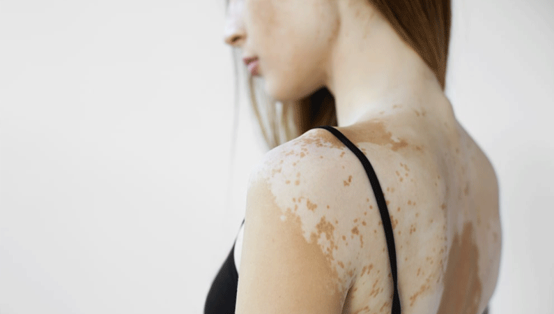 Vitiligo Treatment in Mumbai