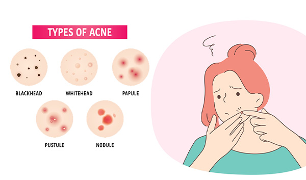 types of acne