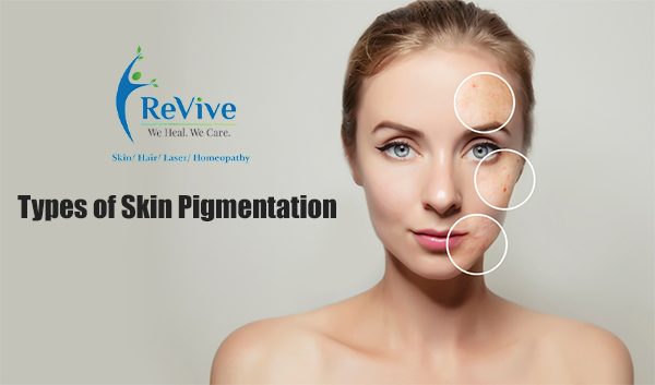 Type of skin pigmentation