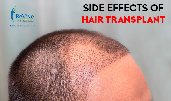 Hair Transplant Treatment Procedure Cost Recovery Side Effects And More