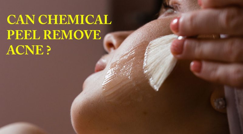Can Chemical Peel Remove Acne
