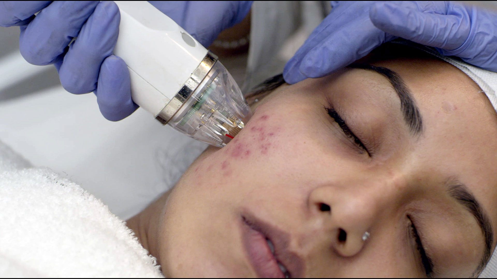 Microneedling with Radiofrequency (MNRF) with PRP