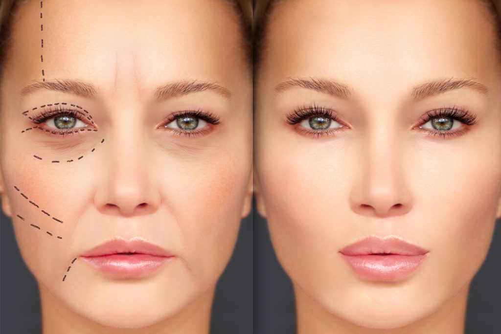 What are the benefits of cosmetic fillers