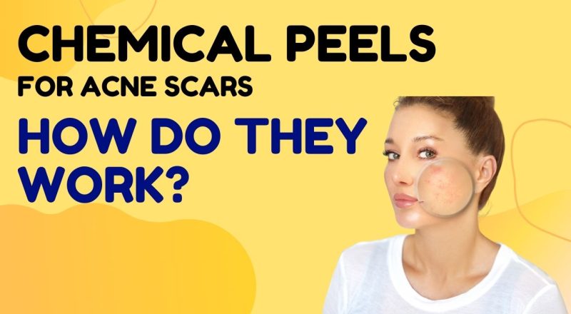 Chemical Peels For Acne Scars, Do They Work