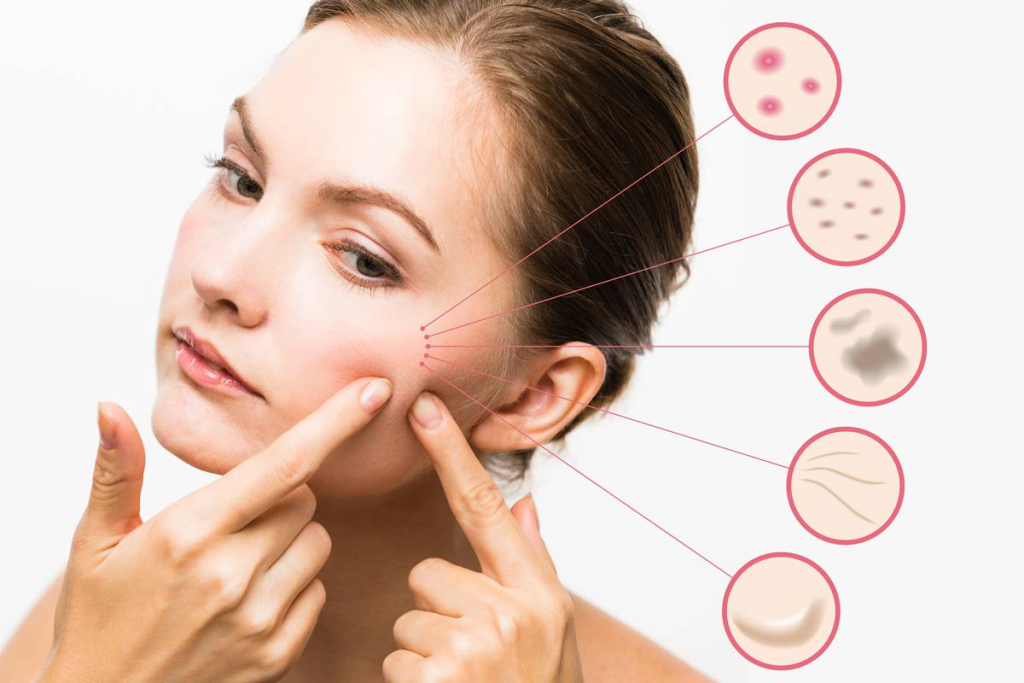 Understanding Acne Scars