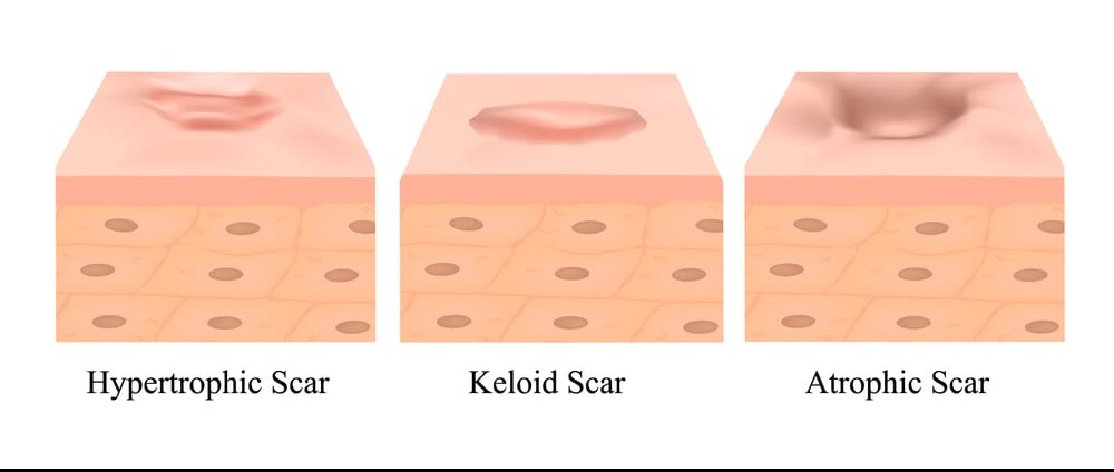 Atrophic Scars, Hypertrophic or Keloid Scars