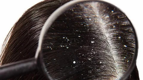 Treating Dandruff