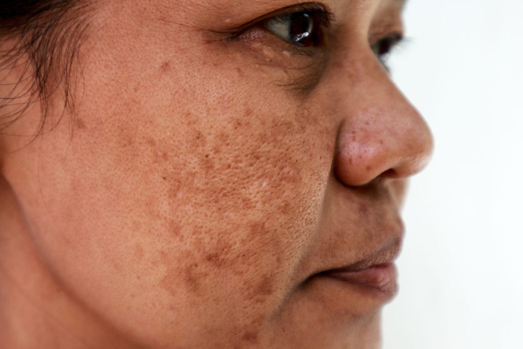 Causes of Melasma