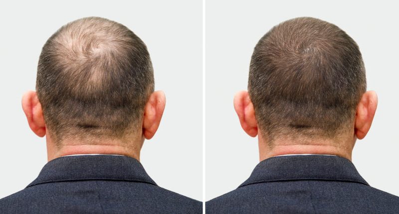 How PRPTherapy Works to Stimulate Hair Growth