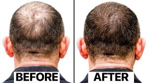 Benefits of Exosome Therapy for Hair Restoration in Mumbai Wiyh Dr. Manisha Saney