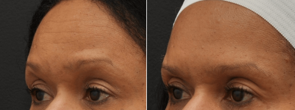 Choosing the Right Botox Clinic in Mumbai