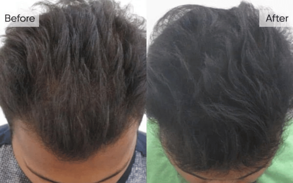 Key Benefits of GFC Therapy for Hair Growth