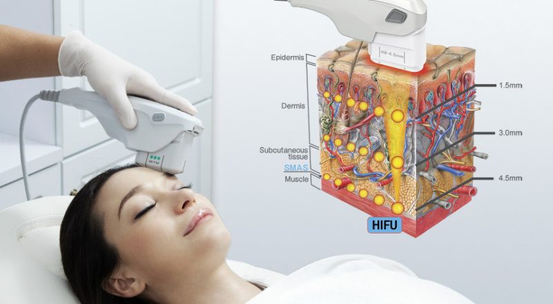 How HIFU Can Help You Achieve Younger, Firmer Skin