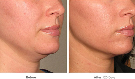 HIFU treatment in Kurla Mumbai by Dr. Manishs Saney