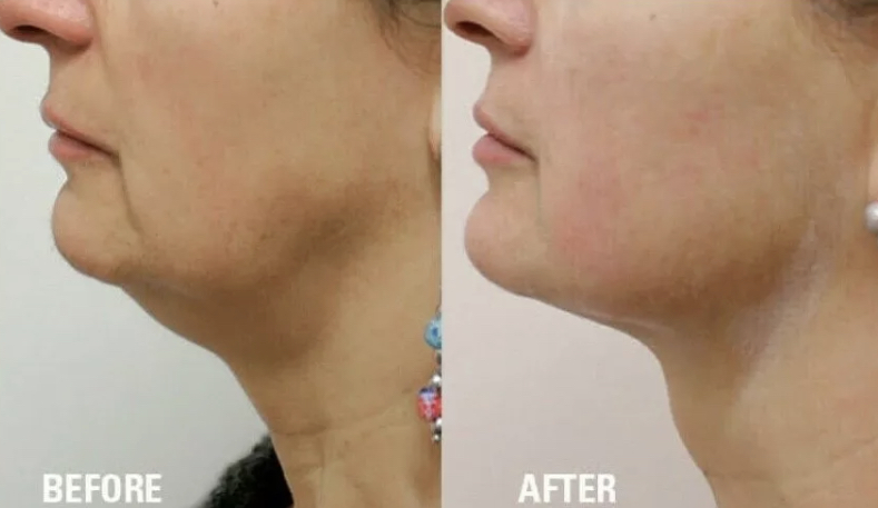 HIFU treatment in Kurla Mumbai by Dr. Manishs Saney