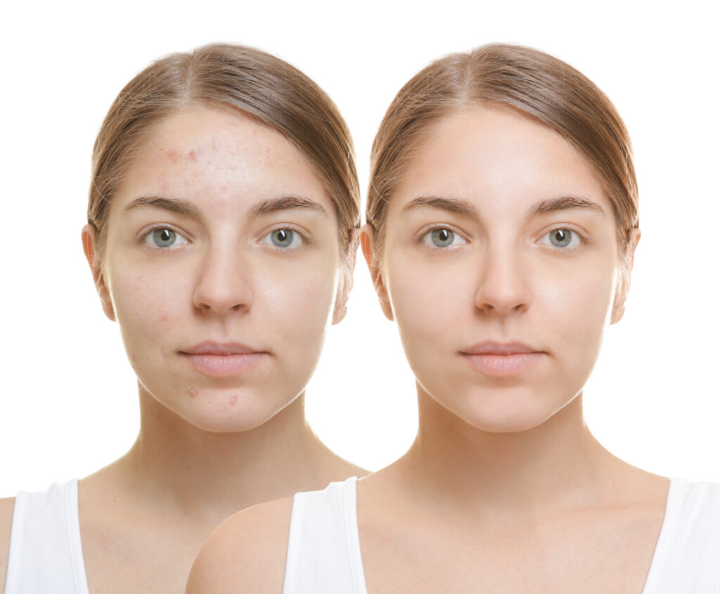 Hydrafacial Treatment in Mumbai by Dr. Manisha Sanaey