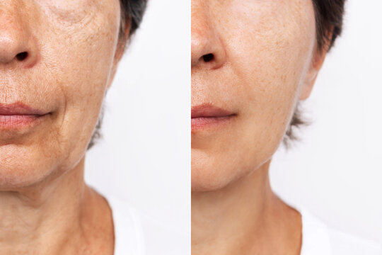 What Are Anti-Aging Injections?