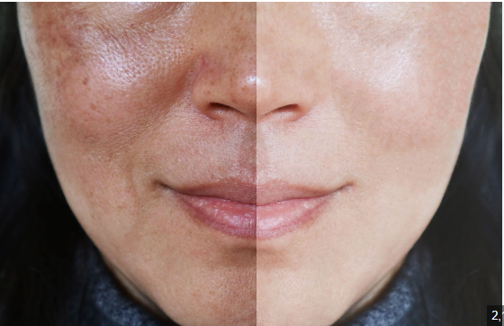 What is a Hydrafacial?