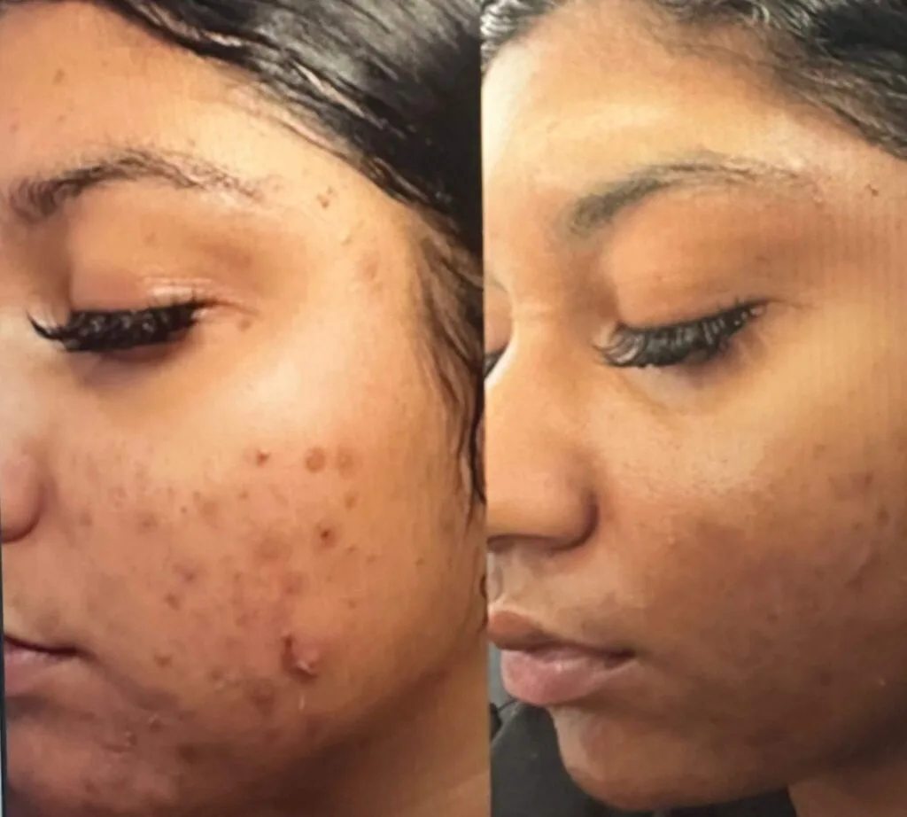 Chemical Peels